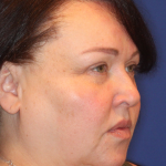 Ultherapy Before & After Patient #15608