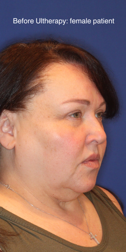 Ultherapy Before & After Patient #15608