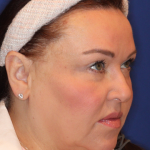 Ultherapy Before & After Patient #15608