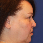 Ultherapy Before & After Patient #15608