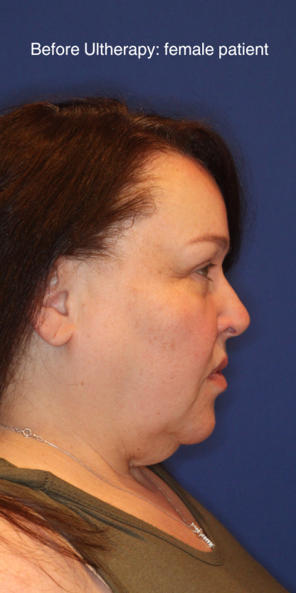 Ultherapy Before & After Patient #15608