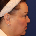 Ultherapy Before & After Patient #15608