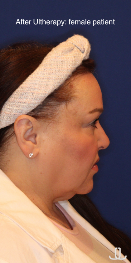 Ultherapy Before & After Patient #15608