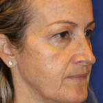 Ultherapy Before & After Patient #13322