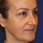 Ultherapy Before & After Patient #13322