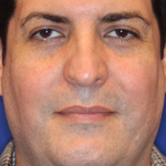 Ultherapy Before & After Patient #13320