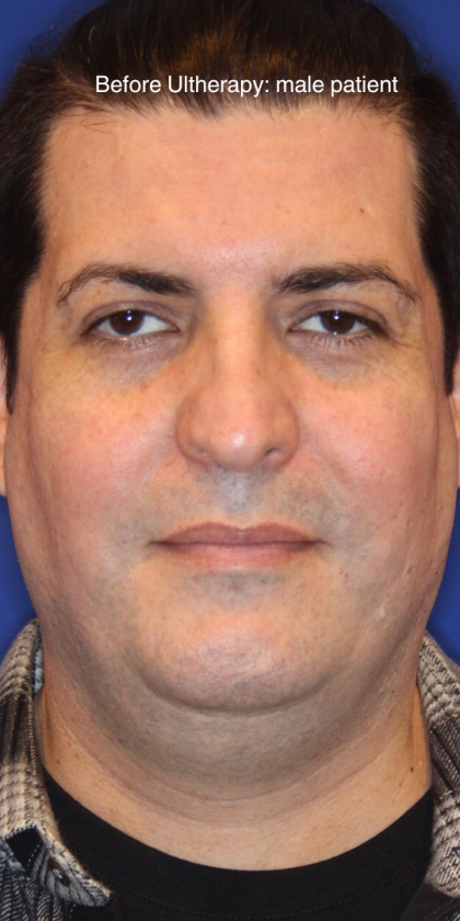 Ultherapy Before & After Patient #13320