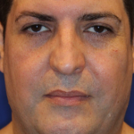 Ultherapy Before & After Patient #13320