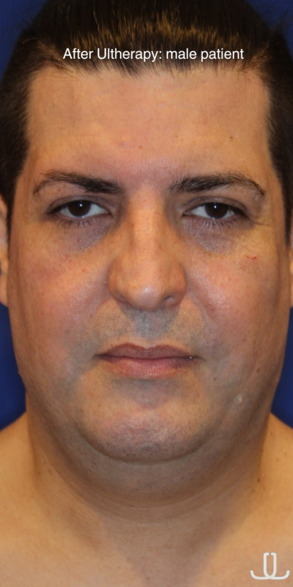 Ultherapy Before & After Patient #13320