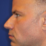 Ultherapy Before & After Patient #13328
