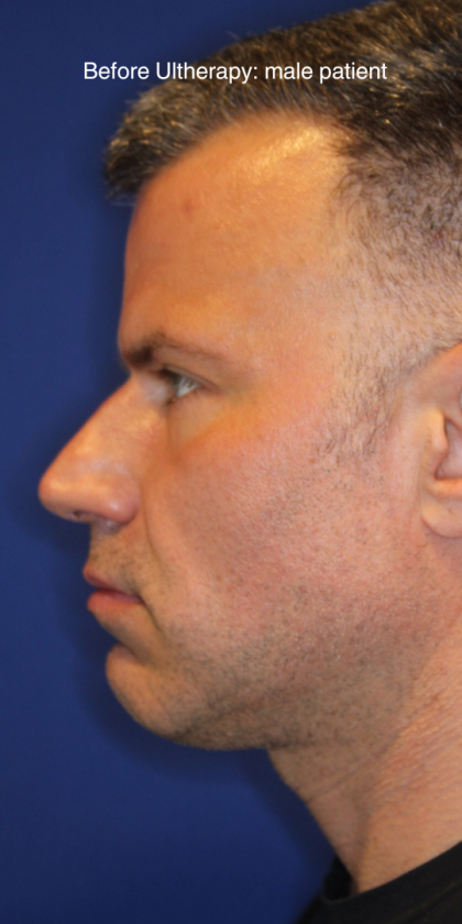 Ultherapy Before & After Patient #13328