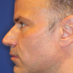 Ultherapy Before & After Patient #13328