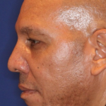 Ultherapy Before & After Patient #15606