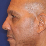 Ultherapy Before & After Patient #15606