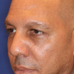 Ultherapy Before & After Patient #15606