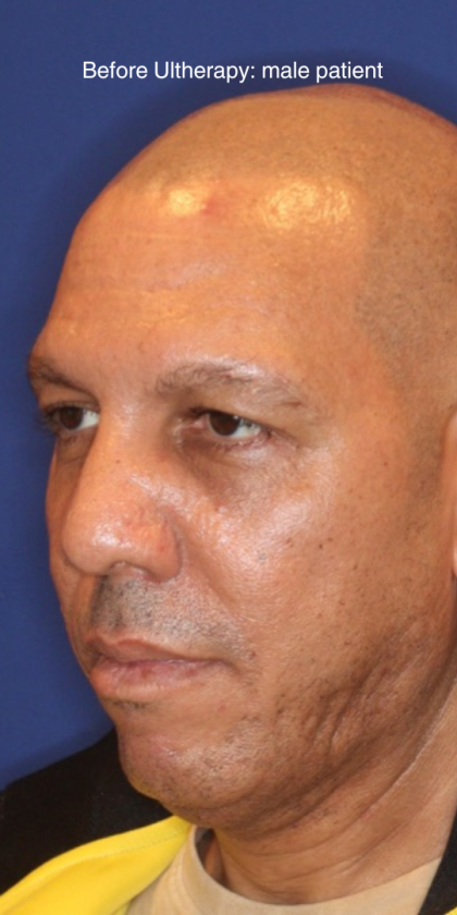 Ultherapy Before & After Patient #15606