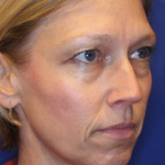Dermal Fillers Before & After Patient #13866