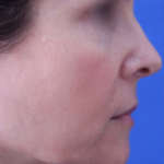 Dermal Fillers Before & After Patient #15394