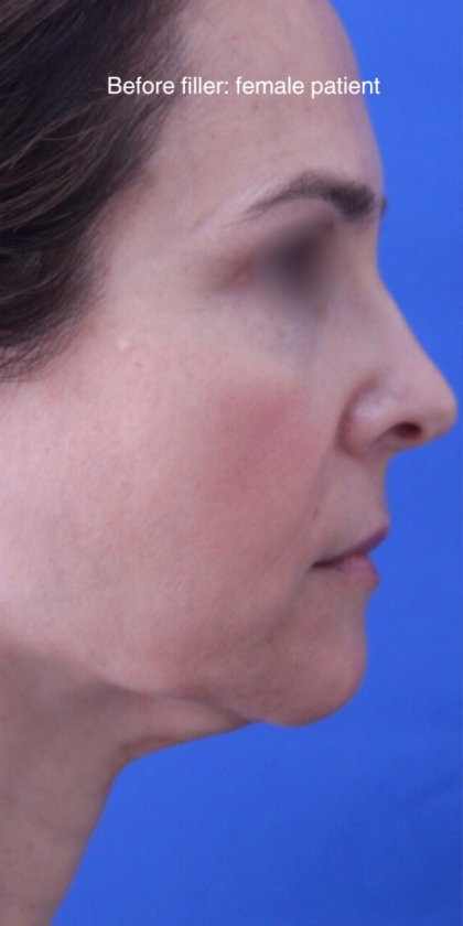 Dermal Fillers Before & After Patient #15394