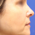 Dermal Fillers Before & After Patient #15394