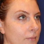 Emface Before & After Patient #13908