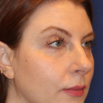 Emface Before & After Patient #13908