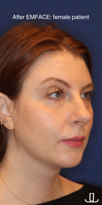 Emface Before & After Patient #13908