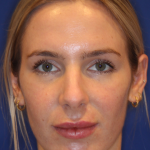JL Facial Balancing Before & After Patient #15543