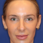 JL Facial Balancing Before & After Patient #15543