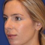 JL Facial Balancing Before & After Patient #15543