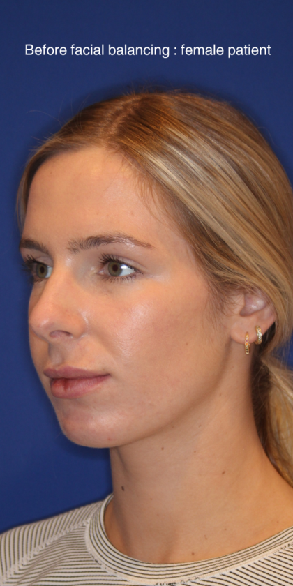 JL Facial Balancing Before & After Patient #15543