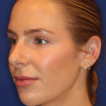 JL Facial Balancing Before & After Patient #15543