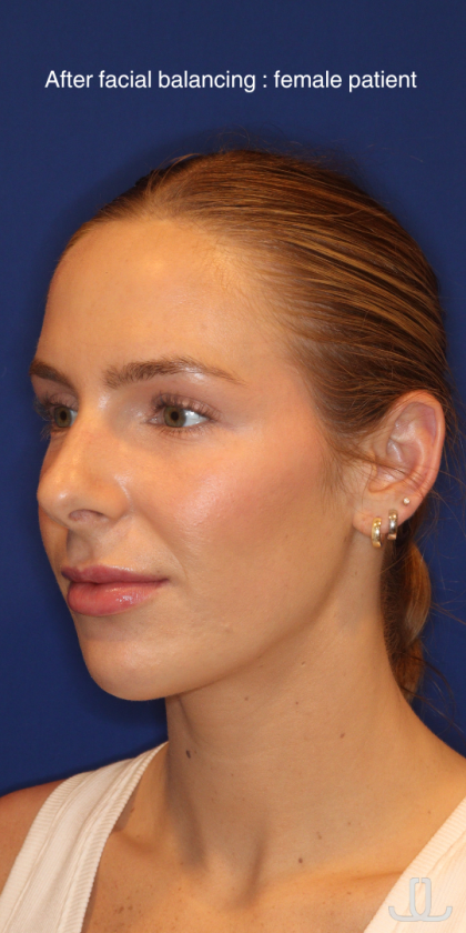 JL Facial Balancing Before & After Patient #15543