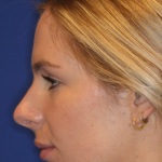 JL Facial Balancing Before & After Patient #15543