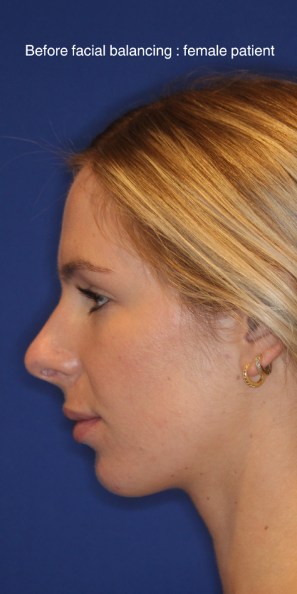 JL Facial Balancing Before & After Patient #15543