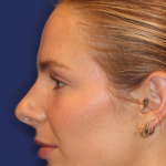 JL Facial Balancing Before & After Patient #15543