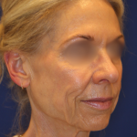 Facelift / Neck Lift Before & After Patient #15101