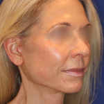 Facelift / Neck Lift Before & After Patient #15101