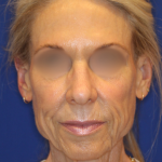 Facelift / Neck Lift Before & After Patient #15101