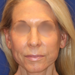 Facelift / Neck Lift Before & After Patient #15101