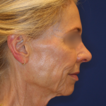 Facelift / Neck Lift Before & After Patient #15101