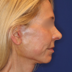 Facelift / Neck Lift Before & After Patient #15101
