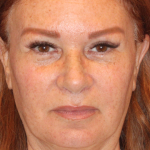 Facelift / Neck Lift Before & After Patient #15102