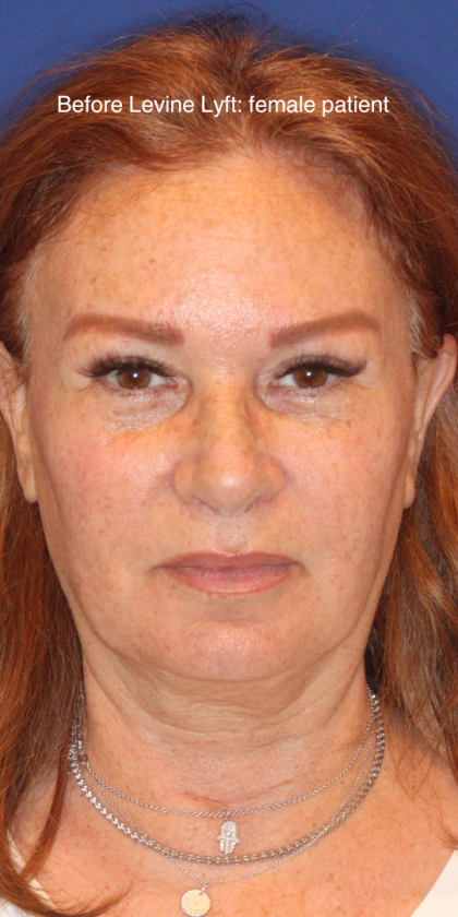 Facelift / Neck Lift Before & After Patient #15102