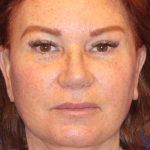 Facelift / Neck Lift Before & After Patient #15102