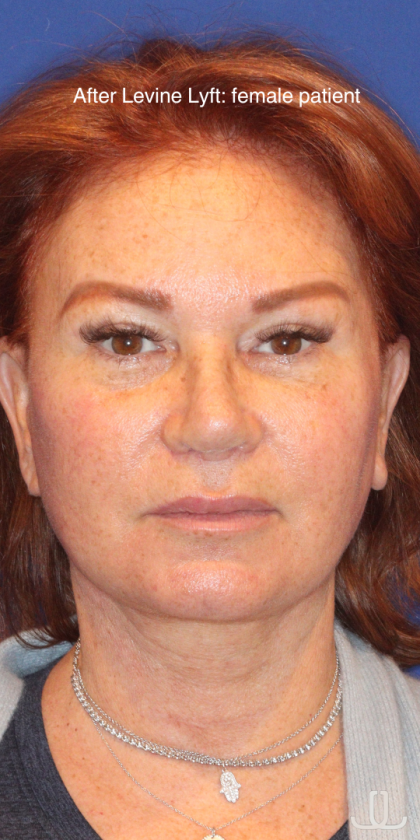 Facelift / Neck Lift Before & After Patient #15102