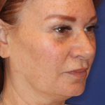 Facelift / Neck Lift Before & After Patient #15102