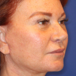 Facelift / Neck Lift Before & After Patient #15102
