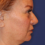 Facelift / Neck Lift Before & After Patient #15102
