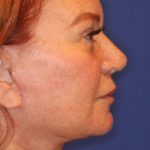 Facelift / Neck Lift Before & After Patient #15102